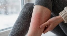 winter skin irritation remedy